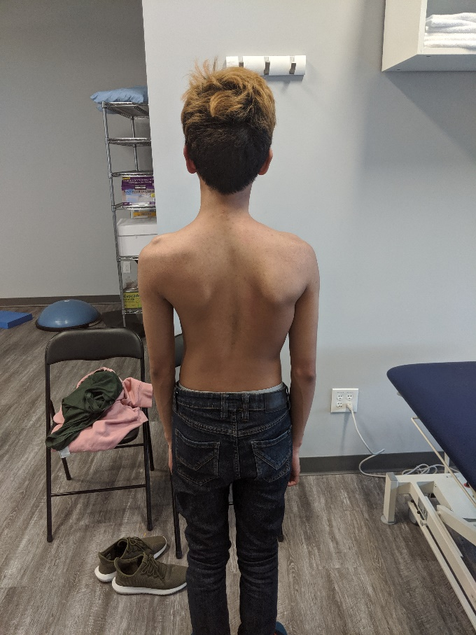 young boy with Scoliosis spine curve