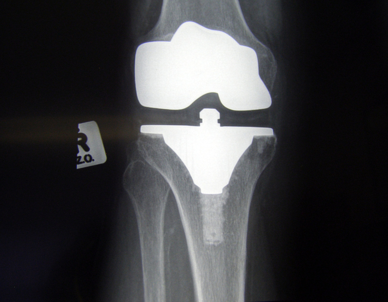 Knee replacement surgery is becoming more and more common as people are liv...