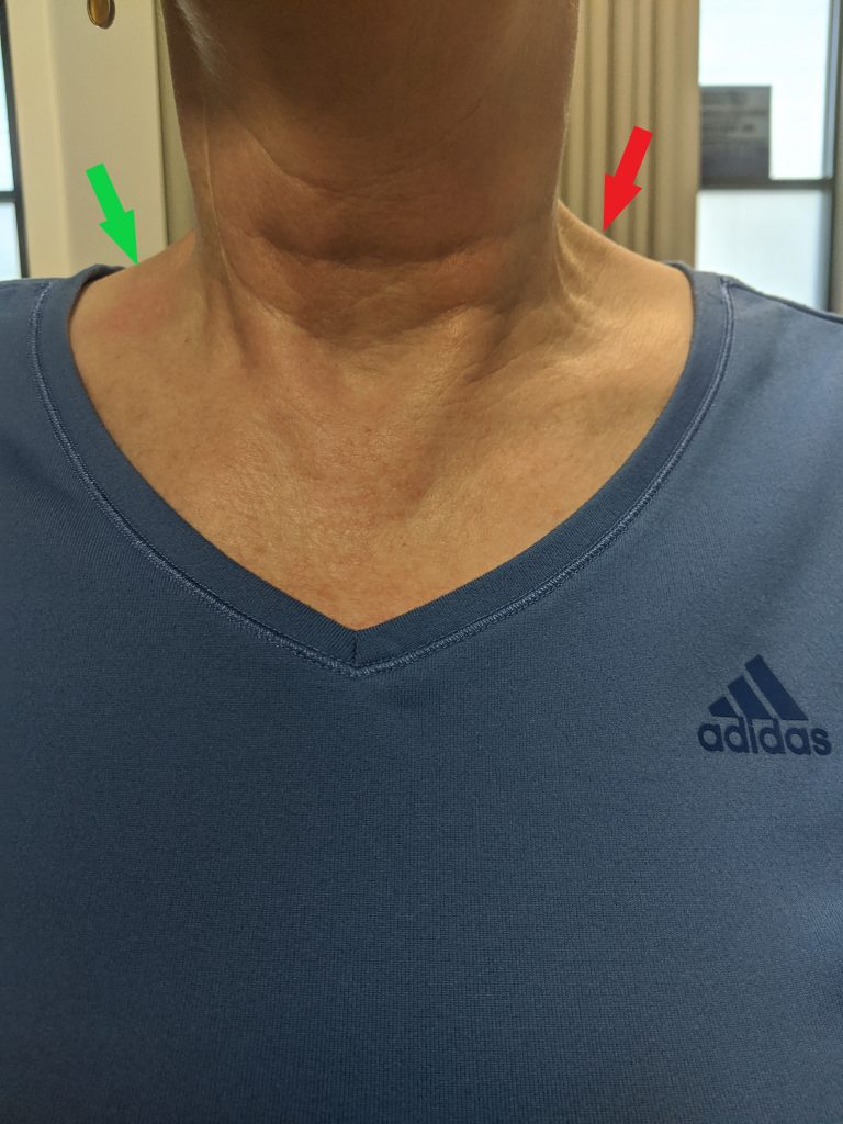 womans neck showing the effect of dry needling treatment