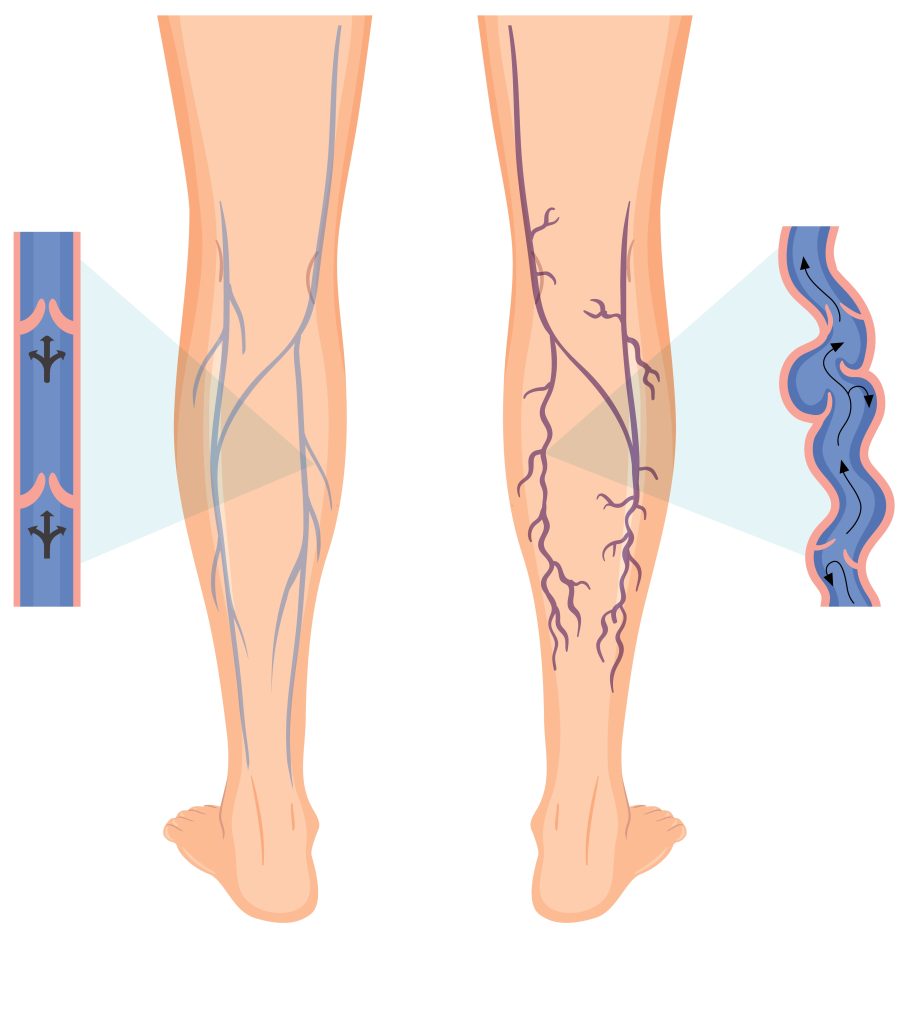 drawing showing the difference between Chronic Venous Insufficiency - spider veins and varicose veins in the leg.