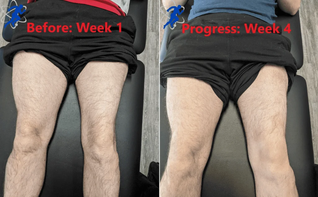 Pre/Post Operative Rehabilitation on quad muscles