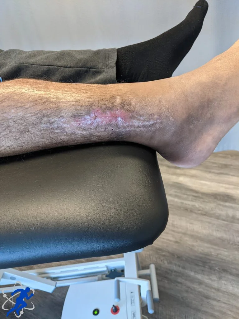 Post Tib/Fib Fracture 