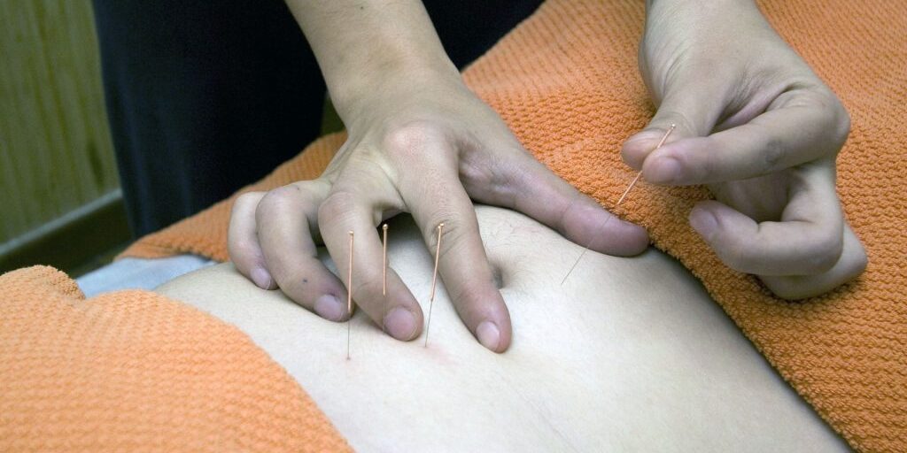 acupuncture needles being inserted into skin.